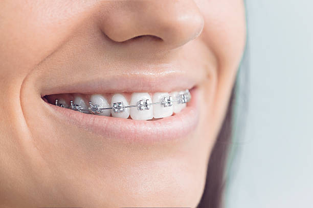 Best Teeth Whitening  in Bakersfield Country Clu, CA